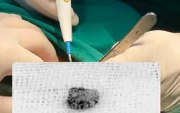 Đi khám vì sưng đau vùng hàm mặt, phát hiện sỏi kích thước lớn