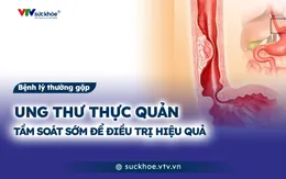 Ung thư thực quản: Tầm soát sớm để điều trị hiệu quả