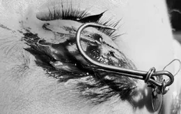 Bé trai 13 tuổi bị móc câu găm trúng vùng mắt phải