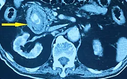 Sỏi túi mật ở người bệnh đái tháo đường: Đừng chủ quan vì nguy cơ biến chứng cao