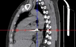 Cứu sống nam bệnh nhân bị đạn bắn xuyên ngực