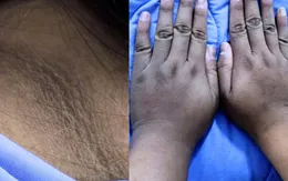 Cô gái 20 tuổi nhập viện vì biến chứng đái tháo đường