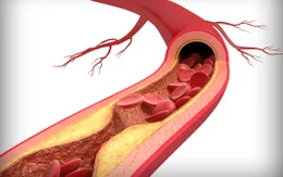Đừng để xơ vữa mạch máu trở thành "kẻ sát nhân thầm lặng"