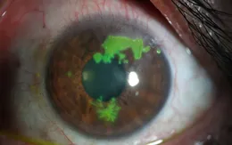 Viêm giác mạc do virus Herpes: Cảnh báo nguy cơ mất thị lực