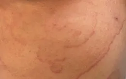 Mùa nắng nóng - thời điểm nấm da dễ bùng phát