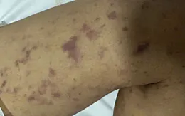2 ca mắc não mô cầu, 1 trẻ đã tử vong tại Đắk Lắk