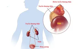 U tuyến thượng thận: Khối u nhỏ, hậu quả khó lường