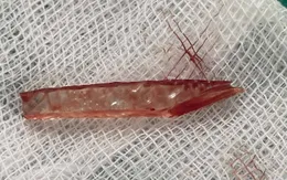 Cứu sống bé 11 tuổi bị mảnh kính đâm thủng ruột