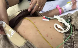 Cứu sống bé trai mắc não mô cầu