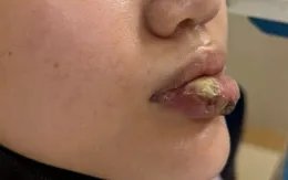 Nhiễm trùng nặng sau tiêm "giải filler"