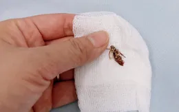 Gắp côn trùng chui vào tai bé trai 11 tháng tuổi