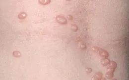 Cẩn trọng với u mềm lây ở trẻ em 