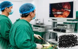 Người bệnh có túi mật chứa gần 1.000 viên sỏi