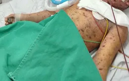 Từ nốt phỏng nhỏ, bé trai nguy kịch vì thủy đậu