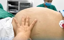 Cắt khối u buồng trứng khổng lồ chứa 10 lít dịch ở bệnh nhân nữ trẻ tuổi