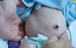 Cứu bé sơ sinh mang khối u quái khổng lồ vùng cùng cụt