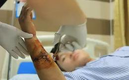 Nối thành công thần kinh, mạch máu cho bệnh nhân tai nạn lao động