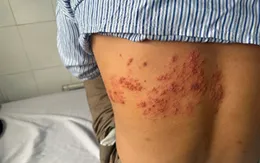 Chủ quan với zona, người đàn ông gặp biến chứng nặng