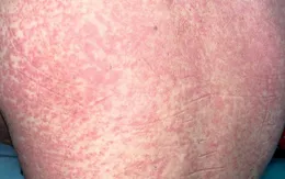 Ban đỏ da tưởng dị ứng, hóa ra nhiễm liên cầu khuẩn