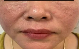 Viêm da tiếp xúc dị ứng vùng mặt do mỹ phẩm