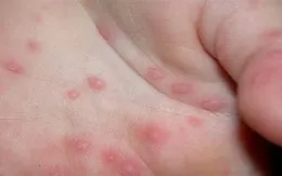 Dấu hiệu dễ nhận biết bệnh tay - chân - miệng