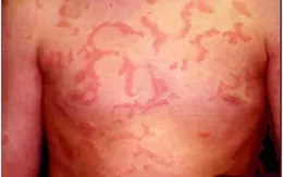 Dị ứng và biện pháp phòng tránh