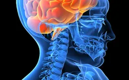 Đột quỵ - Cận kề cái chết