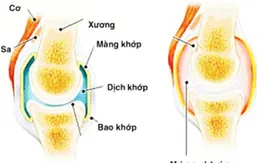 Dùng methotrexat điều trị thấp khớp cho đúng