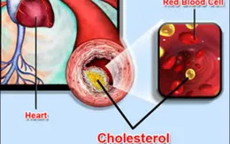 Thận trọng với thuốc hạ mỡ máu nhóm statin