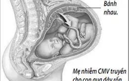 Nhiễm khuẩn bào thai