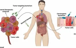Đột phá trong điều trị ung thư: Vi khuẩn biến đổi gen mở ra hy vọng mới