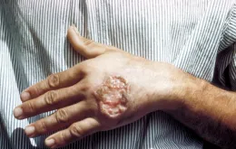 Thái Lan cảnh báo bệnh nhiễm ký sinh trùng Leishmania gây tử vong