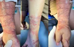 Viêm da tiếp xúc do sứa biển - Mối nguy tiềm ẩn mùa du lịch hè