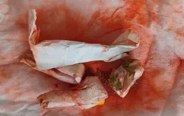 Ngộ độc chì sau khi bôi và uống "thuốc cam" 7 ngày