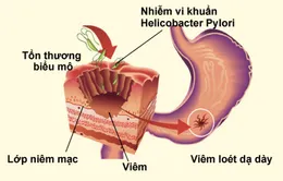 6 điều quan trọng về viêm loét dạ dày ai cũng nên biết