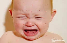 Cần đạt tỷ lệ tối đa 100% trong việc tiêm phòng rubella