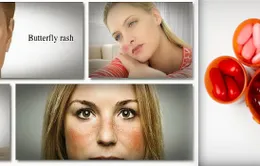 Một số lưu ý trong điều trị bệnh Lupus ban đỏ hệ thống