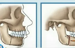 Trẻ em niềng răng tốt nhất ở tuổi 12