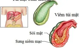 Chớ xem thường triệu chứng viêm túi mật