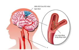 Thiếu máu não - Kẻ "giết người" thầm lặng