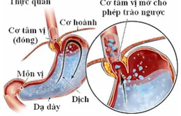 Tìm hiểu về bệnh trào ngược dạ dày - thực quản