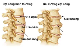 Điều trị bệnh gai cột sống bằng vật lý trị liệu