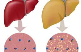Gan nhiễm mỡ - Sát thủ thầm lặng khó nhận biết