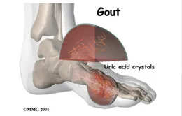 Vì sao bệnh gout bùng phát mạnh vào mùa xuân?