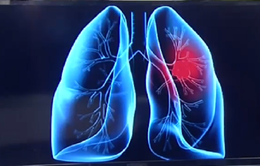 Mỗi năm Việt Nam có 22.000 ca mắc ung thư phổi mới