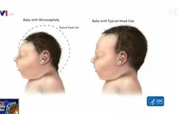 Florida (Mỹ) xác nhận sản phụ đầu tiên nhiễm Zika sinh con đầu nhỏ