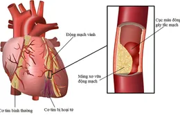 Rối loạn mỡ máu là nguyên nhân gây bệnh tim mạch