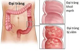 Trò chuyện cùng Dr.ANH: Viêm đại tràng