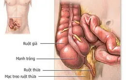 Bệnh viêm đại tràng co thắt dễ tái phát