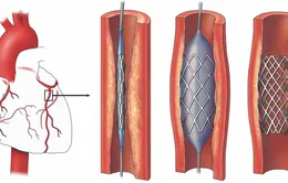 Giải pháp mới cho bệnh nhân mạch vành